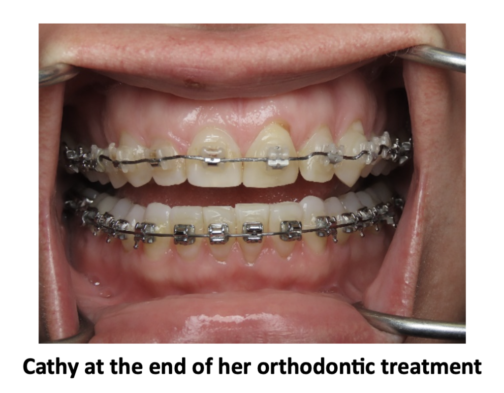 Cathy at the end of her orthodontic treatment